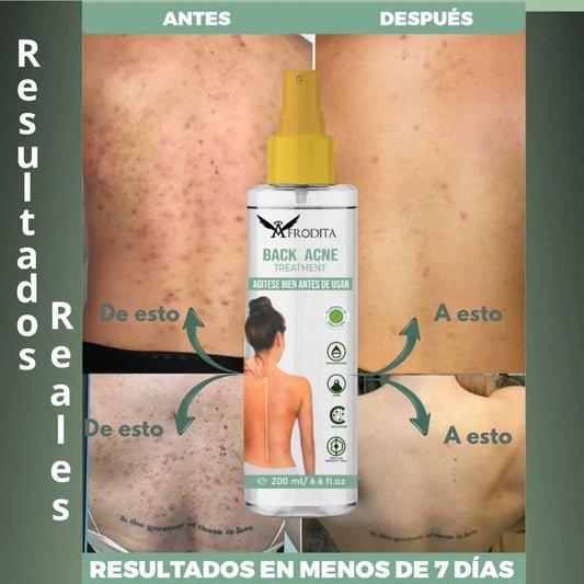 Spray Eliminador de Acné Corporal