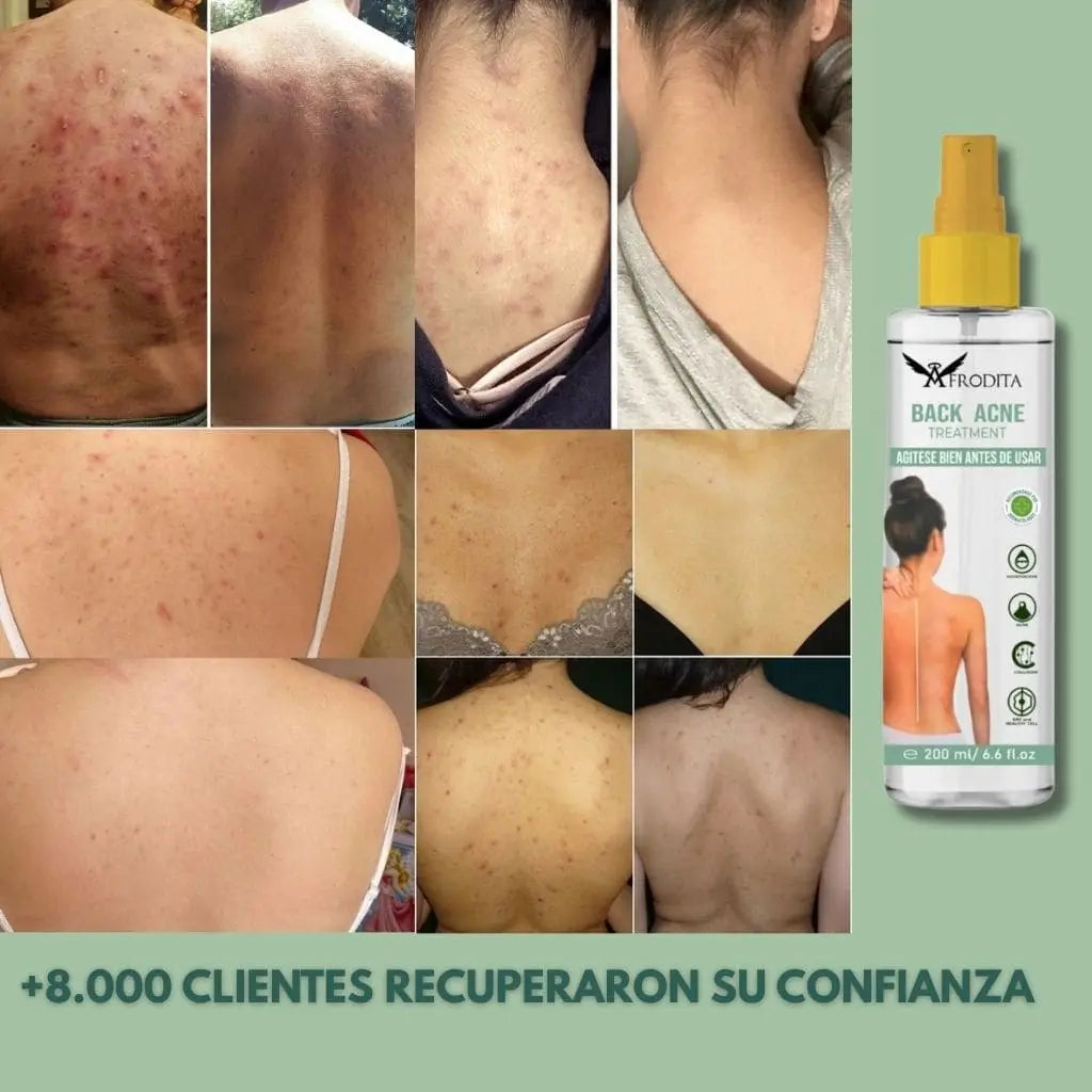 Spray Eliminador de Acné Corporal