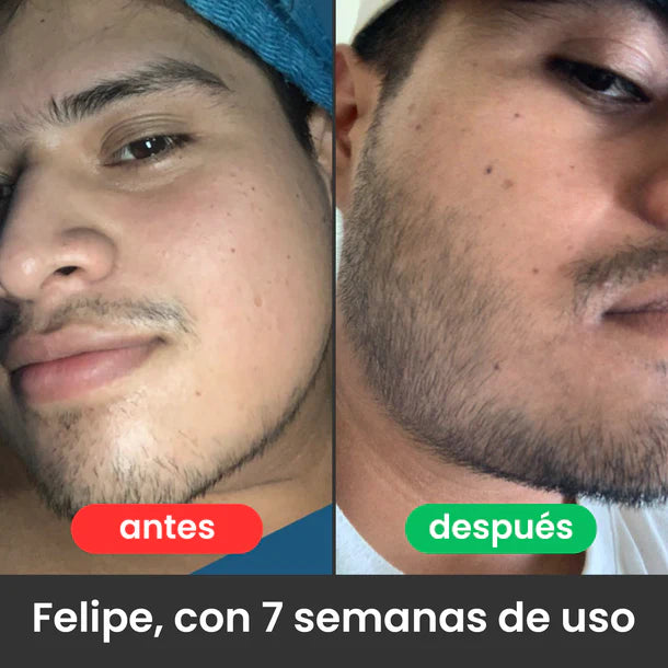 Bálsamo para Crecimiento de Barba Ultra Potente con Minoxidil 20% | 100mL