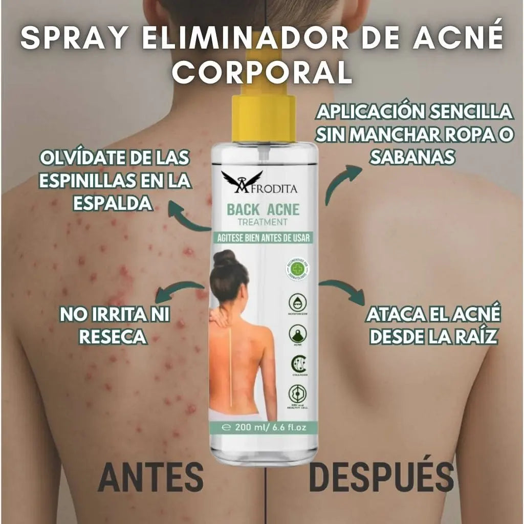 Spray Eliminador de Acné Corporal